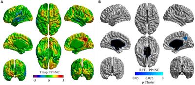 Brain structure alterations in girls with central precocious puberty